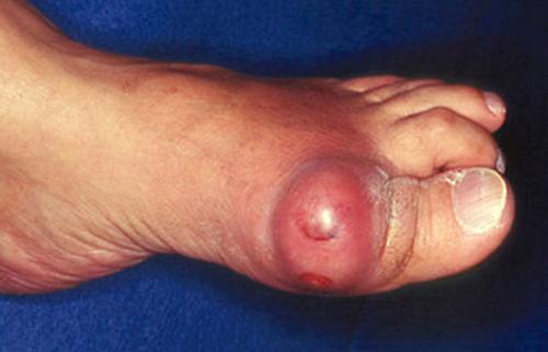 Bệnh GOUT đến từ đâu?