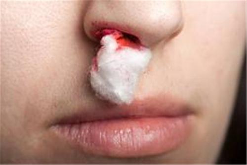 Chứng chảy máu mũi ở trẻ em