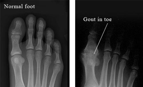 Bệnh GOUT đến từ đâu? Bệnh GOUT đến từ đâu?