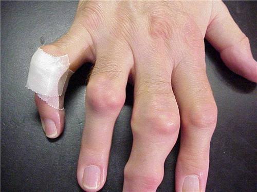 Bệnh GOUT đến từ đâu?