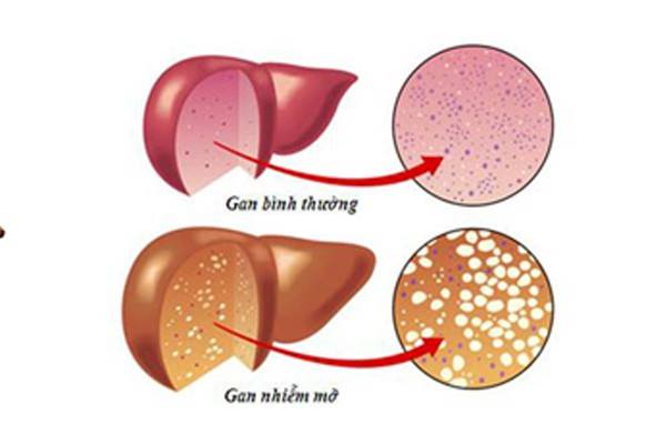 Giảm béo quá nhanh có thể dẫn đến gan nhiễm mỡ Giảm béo quá nhanh có thể dẫn đến gan nhiễm mỡ