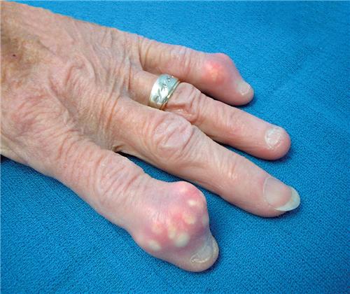 Bệnh GOUT đến từ đâu?