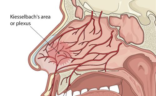 Chứng chảy máu mũi ở trẻ em