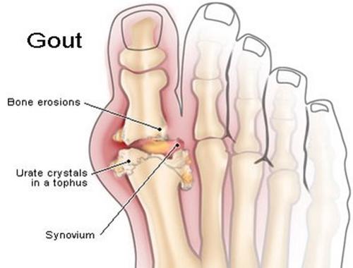 Bệnh GOUT đến từ đâu?