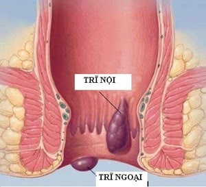 Bạn biết gì về bệnh trĩ? Bạn biết gì về bệnh trĩ?