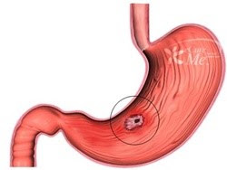Loét dạ dày tá tràng: Bệnh dễ hiểu lầm Loét dạ dày tá tràng: Bệnh dễ hiểu lầm