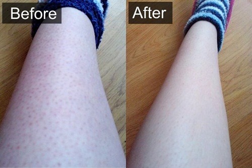 Trị khỏi viêm nang lông với nguyên liệu rẻ tiền mà hiệu quả