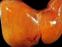 Cách phòng bệnh gan nhiễm mỡ Cách phòng bệnh gan nhiễm mỡ
