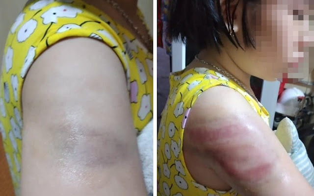 Phụ huynh tố giáo viên đánh học sinh bầm tím tay vì... viết bài chậm