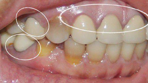 Bất ngờ với cách lấy cao răng không cần đi nha sĩ